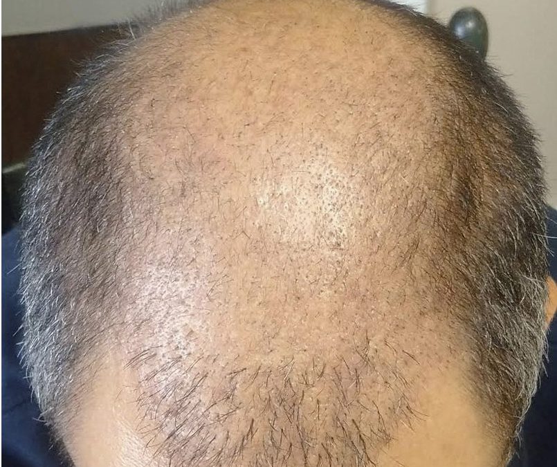 CASE STUDY – Day 21 – FUE and Scar Repair