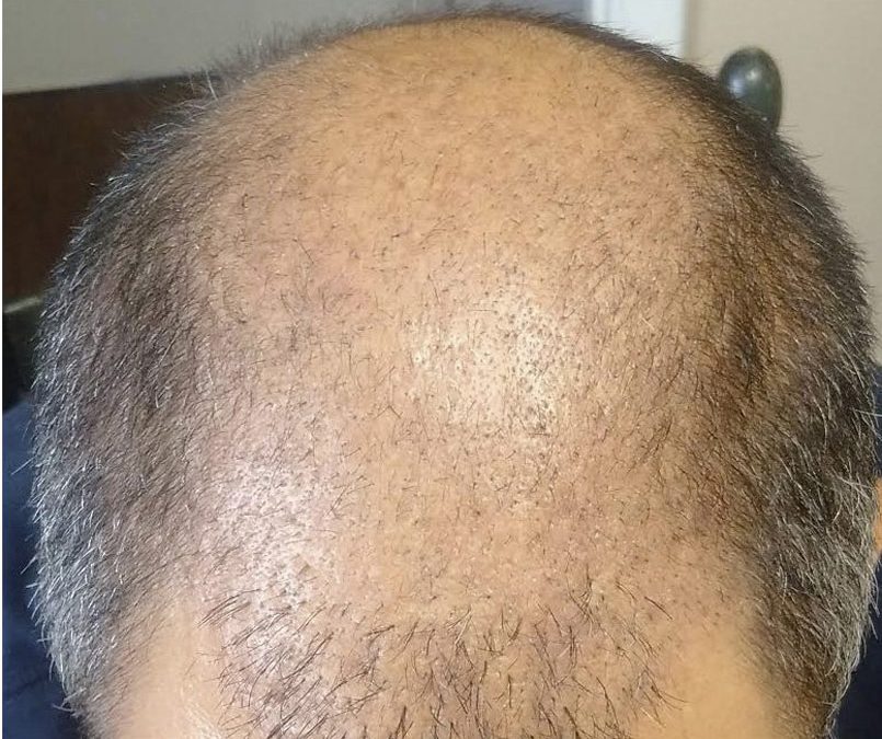 CASE STUDY – 3000 Graft FUE – DAY 28