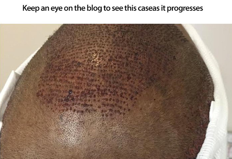 1500 Graft FUE – 35 Year Old African American Patient