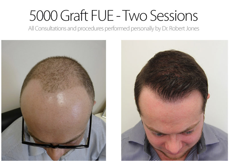 Great FUE Case – 5000 Graft FUE