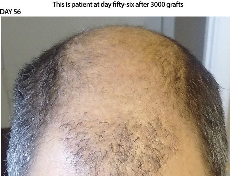 CASE STUDY – 3000 Graft FUE – DAY 56