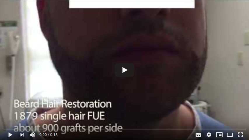 1879 Graft Beard Transplant – Day Of Surgery