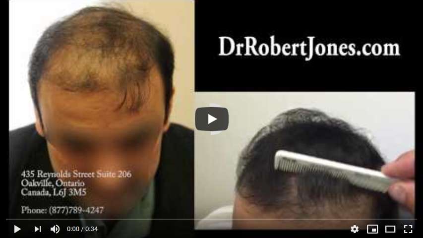 VIDEO – 3500 Graft Strip Surgery – 47 Year Old Male – 8 Months Post Op