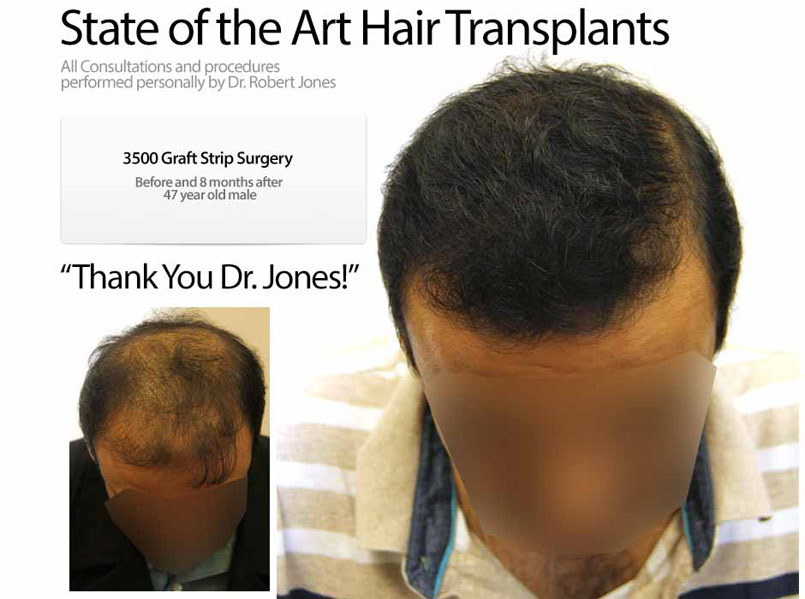 3500 Graft Strip Surgery – 47 Year Old Male