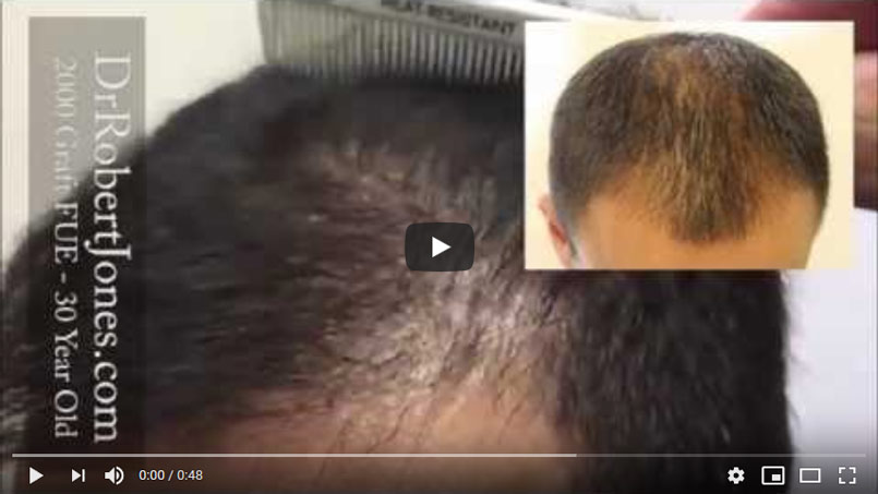 VIDEO – 2000 Graft FUE – 30 Year Old Male – 1 Year Post Op
