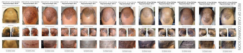 Case Update – 3000 Graft FUE – Plug Repair – DAY 150