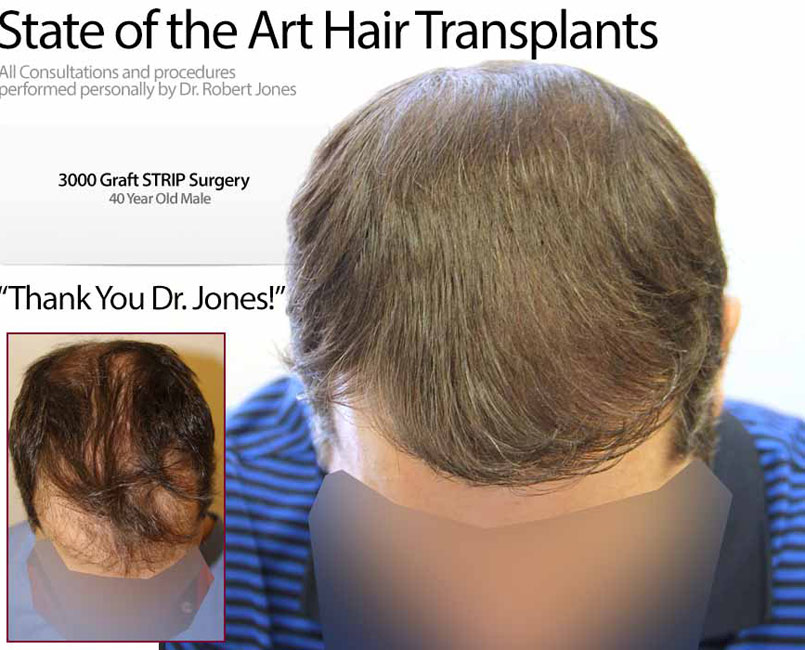 New Strip Case – 3000 Grafts – 40 Year Old Male