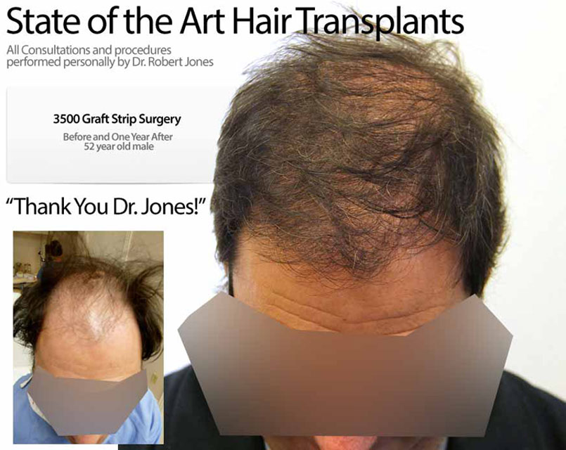 Strip Surgery – 3500 Grafts – 52 Year Old Male