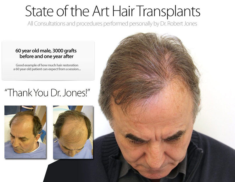 5 questions to ask yourself before getting a hair transplant