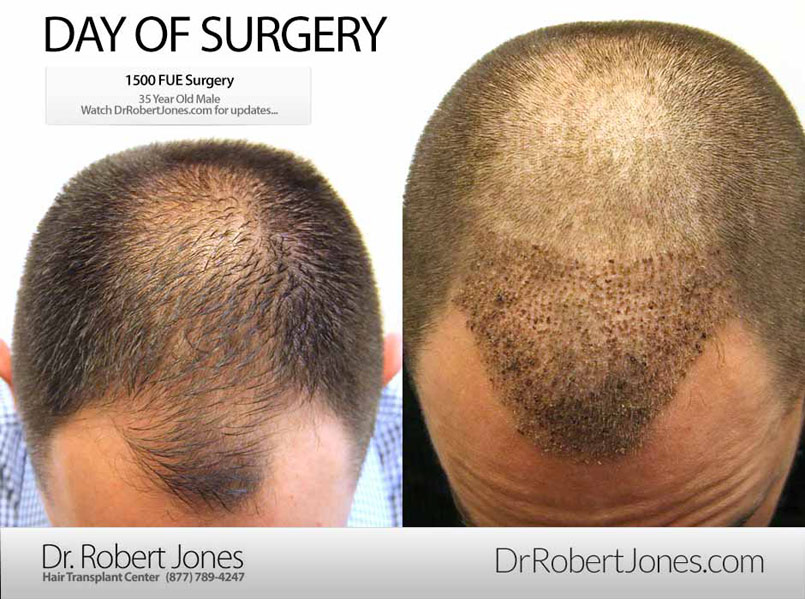Day Of Surgery – CASE STUDY – 1500 FUE Grafts – 35 Year Old Male Patient