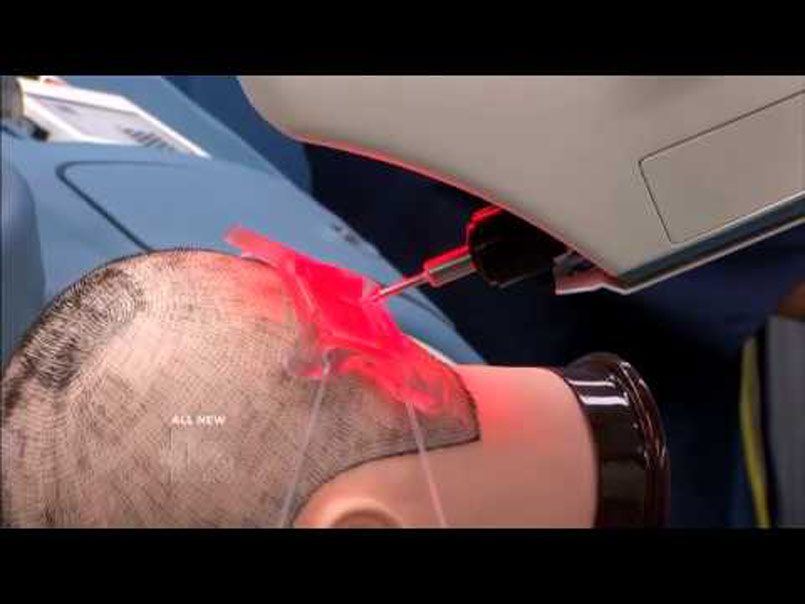 Robotics and The Future Of Hair Transplants…