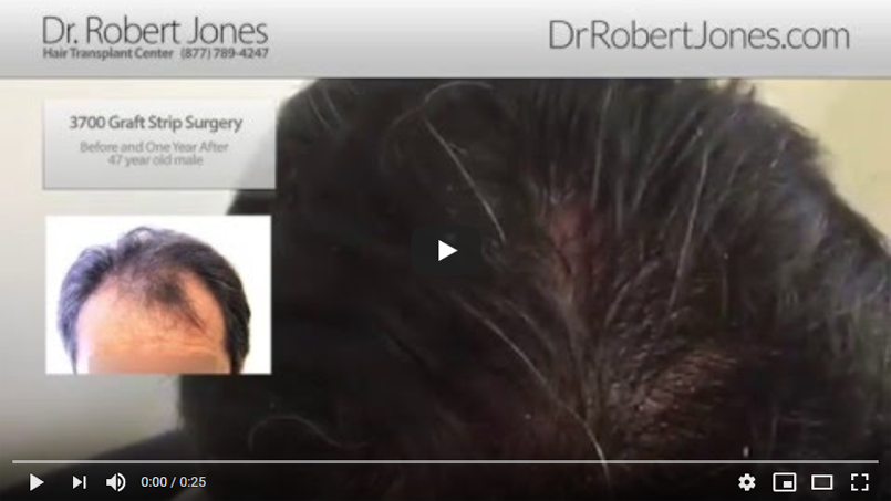 VIDEO CASE STUDY – 3700 Graft Strip Surgery – 47 Year Old Male