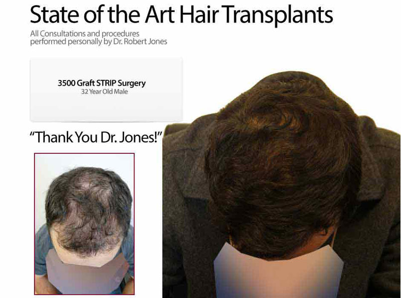 3500 GRAFT Strip Surgery – 32 Year Old Male