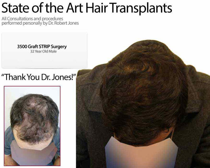 Case Study – 3500 Graft Strip Surgery – 32 Year Old Male