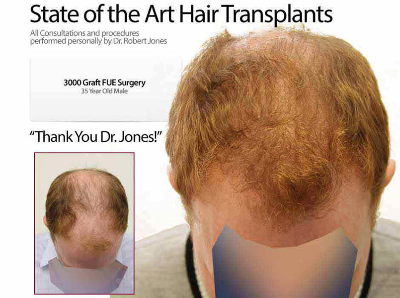 3000 GRAFT FUE – 30 Year Old Male