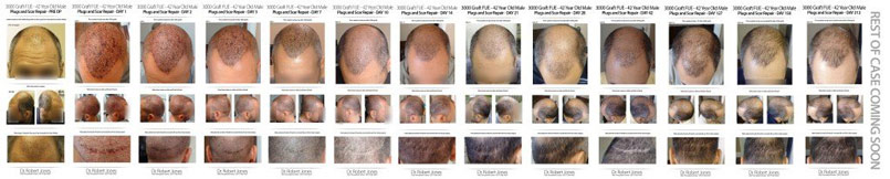 Day 212 – 3000 Graft FUE – 42 Year Old Male