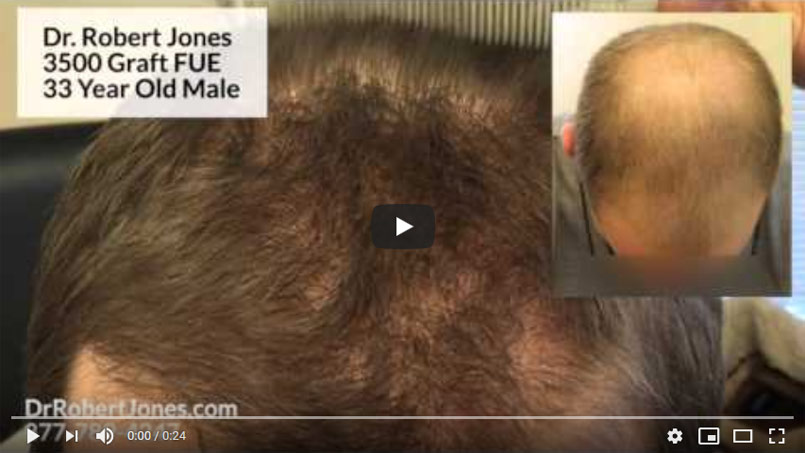 VIDEO CASE STUDY – 3500 Graft FUE – 33 Year Old Male