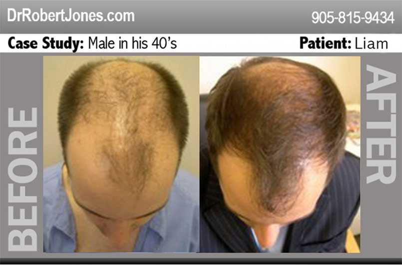 Celebrity Hair Loss – No exception to the rule of mother nature!