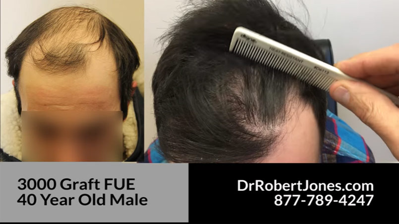 3000 Graft FUE – AMAZING RESULT – 40 Year Old Male – VIDEO