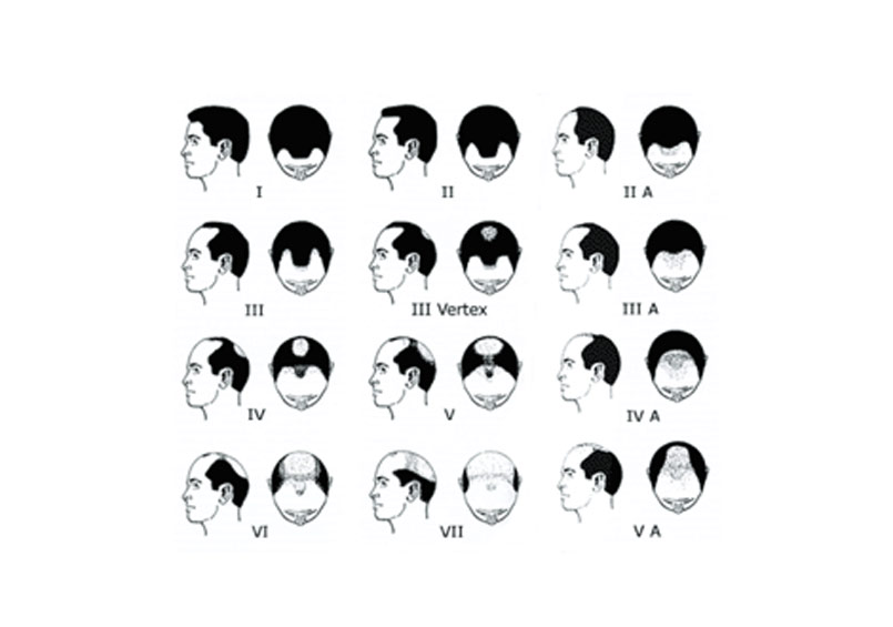 Why does balding affect people differently?