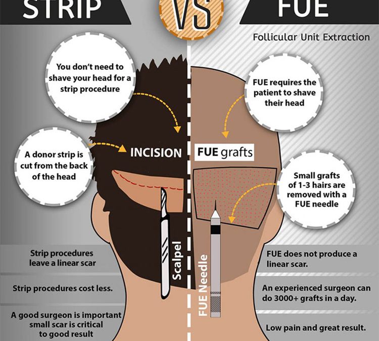 FUE vs Strip Hair Transplants (INFOGRAPHIC)
