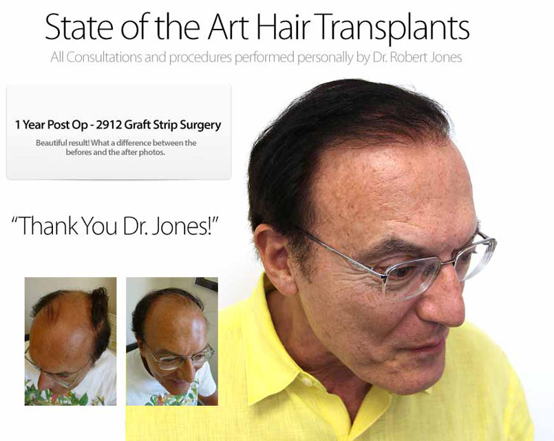 Thinking about a hair transplant?