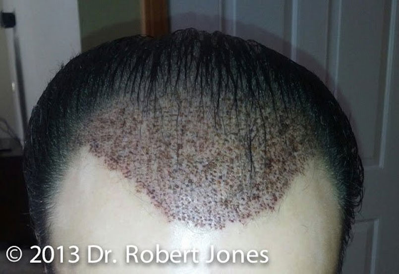 How Long Does it Take to Recover From a Hair Transplant?