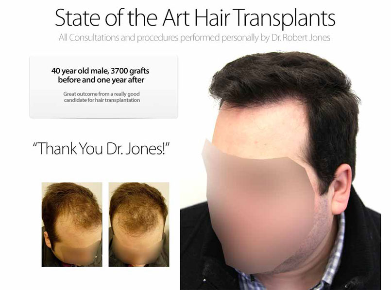 When should you get a hair transplant?