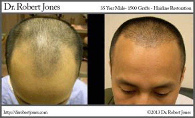 Should I Consider a Hair Transplant If I Only Have Minimal Hair Loss?