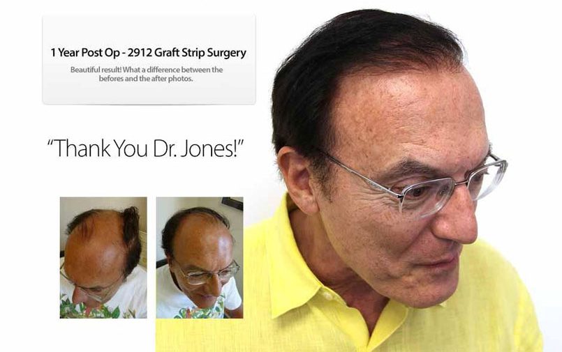How Many Hair Grafts are Needed?