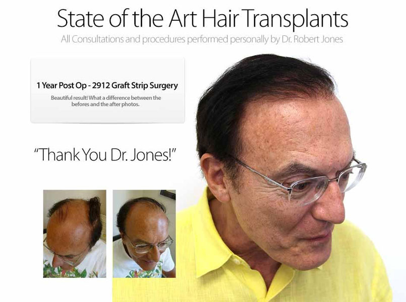 How Many Hair Grafts are Needed?