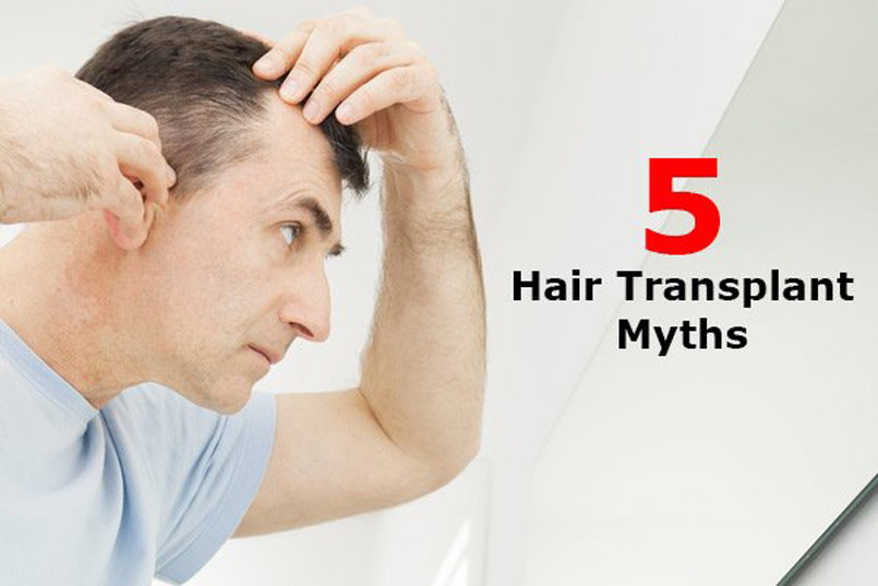 Five Common Hair Transplant Myths