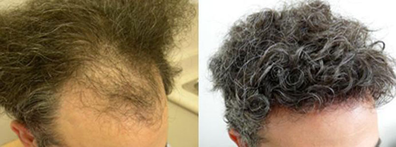 Undetectable hair transplants – banish those bald spots!