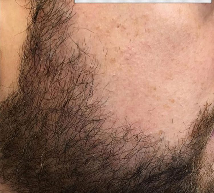 1500 Graft Beard Hair FUE – before and after – 6 months