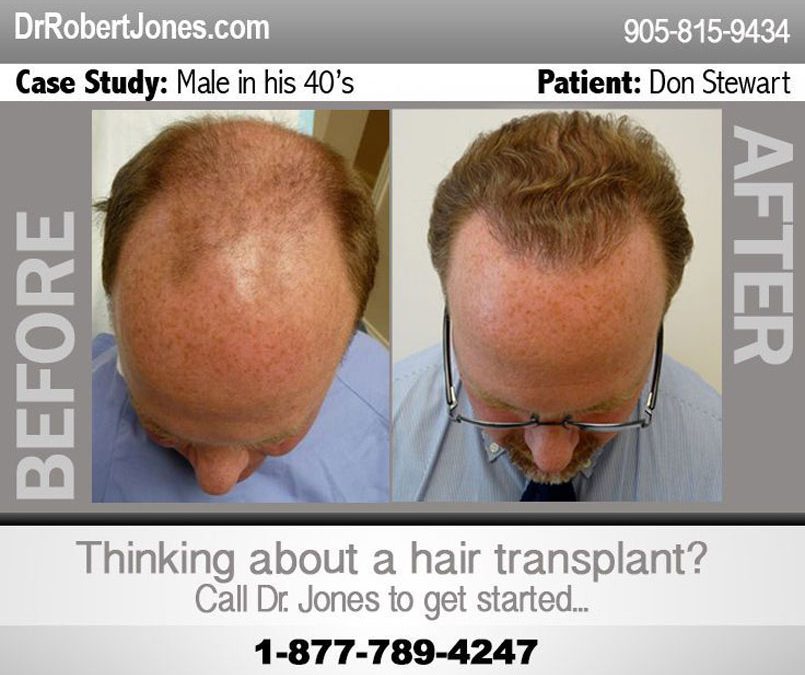 Hair Transplant Infographic – DON