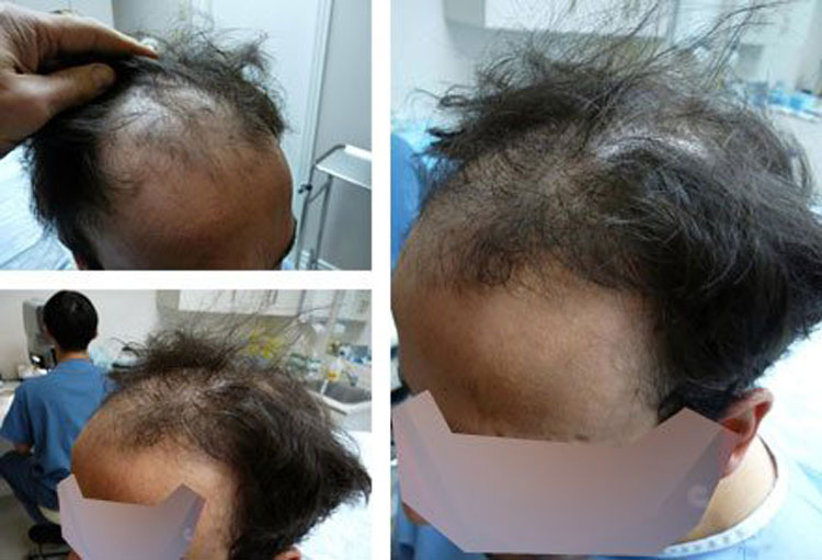 Case Study – 3800 Graft strip hair transplant, 38 year old male