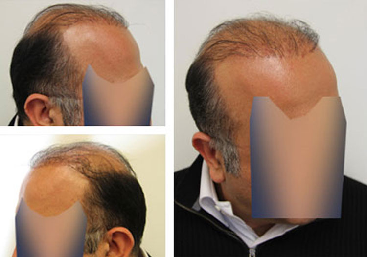 Case Study – Before and after Plug repair, 50 year old male, 5000 grafts