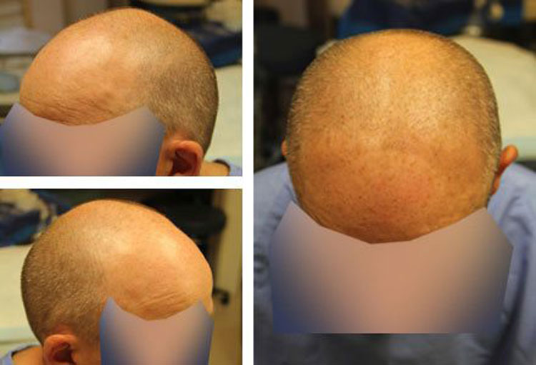 Case Study – 3000 Graft FUE, 45 year old male