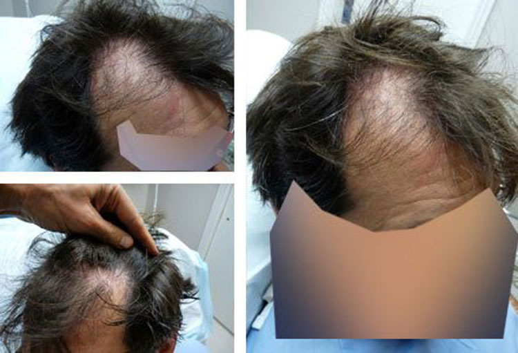 Case Study – Before and After hairline repair, 48 year old male, 1800 grafts