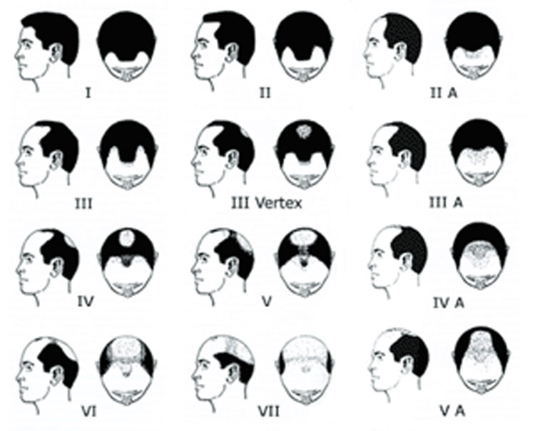 Receding hairline vs thinning at the crown – which is worse?