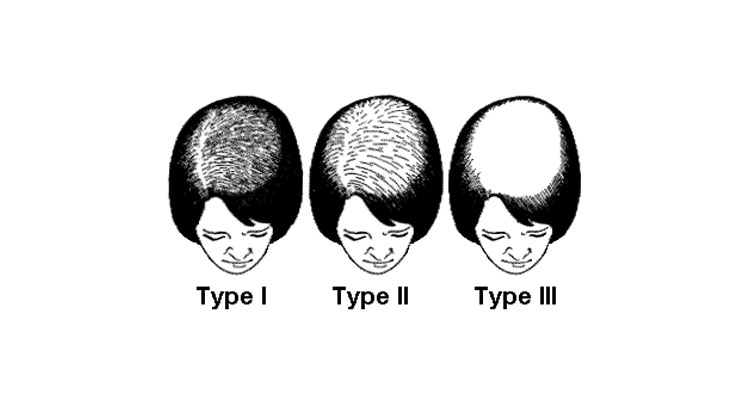 What is Alopecia?