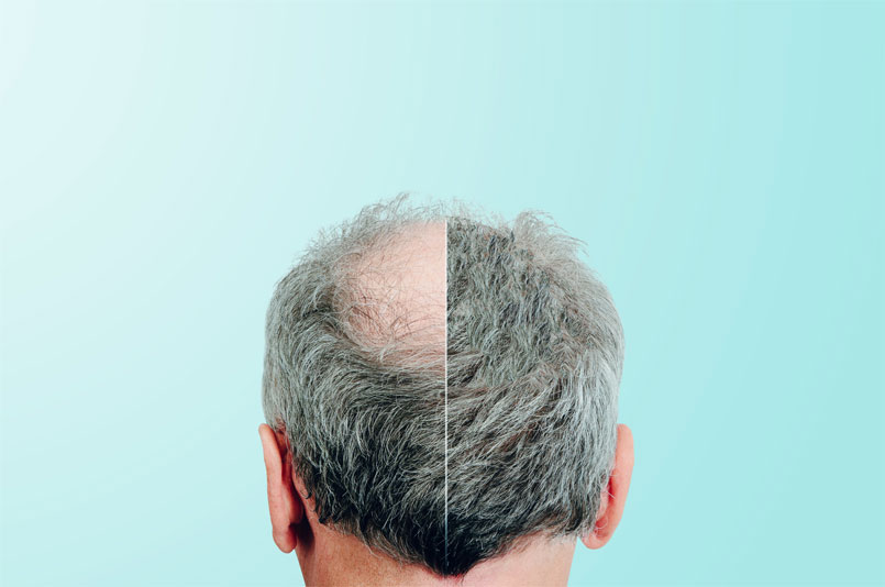 Amazing Hair Transplant Story – 3 Years Later