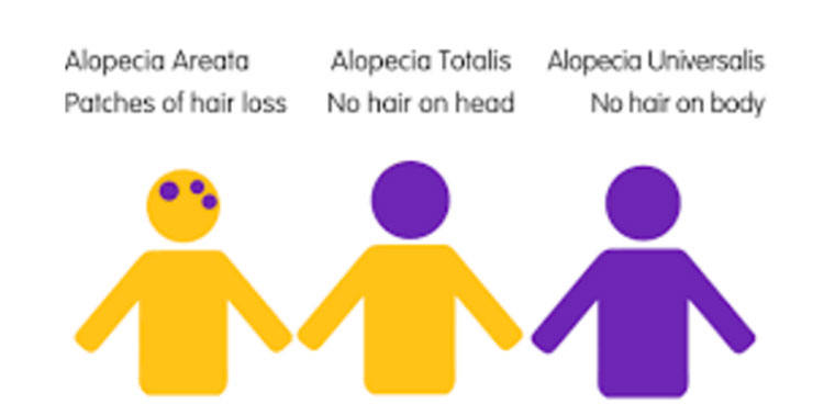 Different Types of Alopecia.