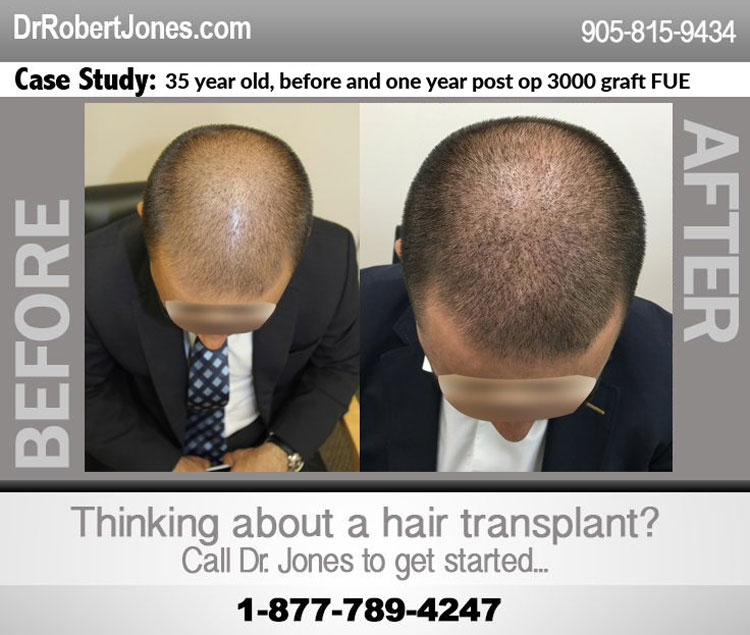 35 year old before and one year post op 3000 graft FUE