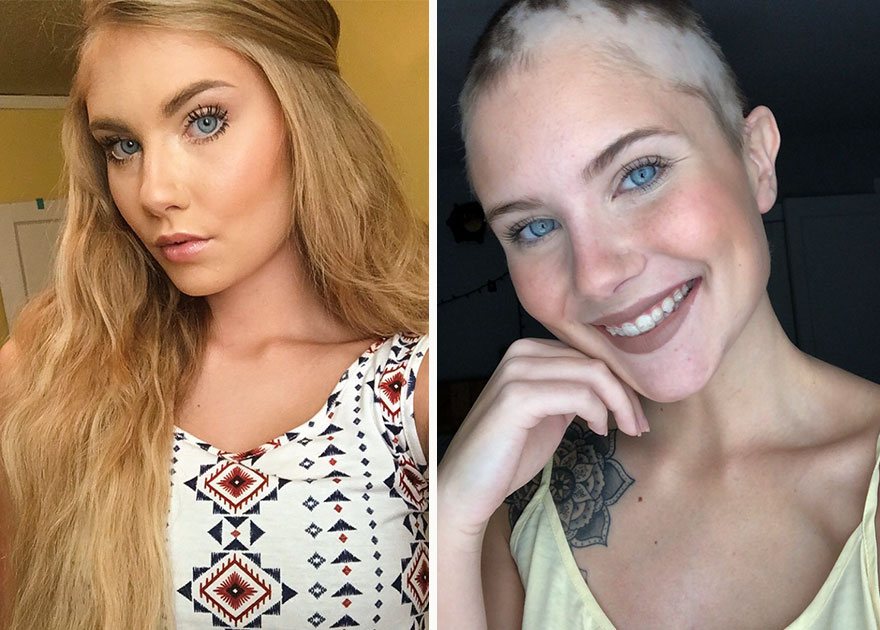 The Beauty of Embracing Alopecia