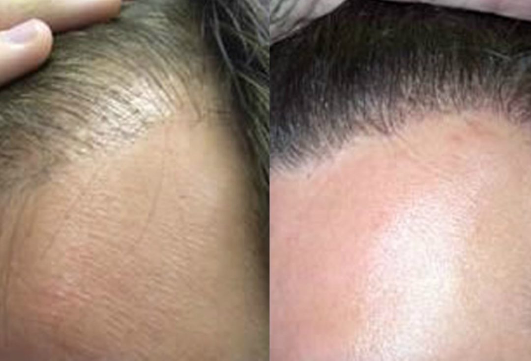 Before And After Hair Line Procedure, 1500 FUE grafts Toronto Hair
