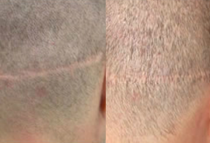 Before And After Scar Repair, 34 years old male, 200 grafts