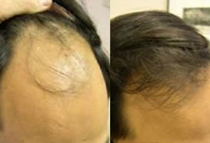 Before And After, 35 year old male, 2000 graft