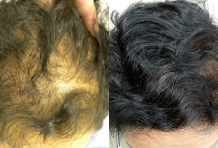 Before And After, 50 year old female, 2000 grafts