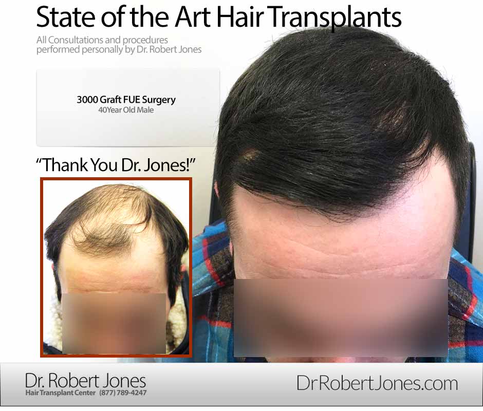 Before And After Graft FUE Procedure, 40 Year Old Male, 3000 Grafts